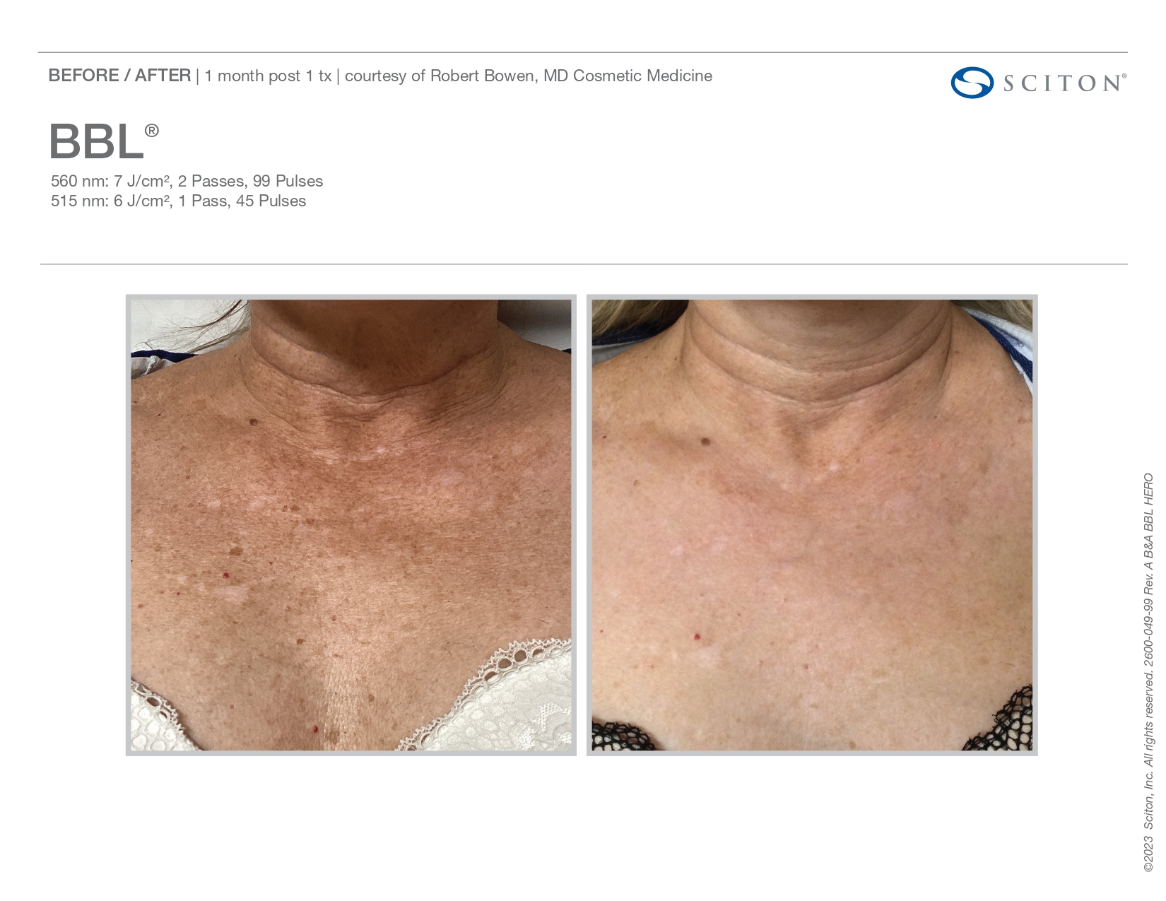 Elle Skin Beauty_& Co_BBL_Before After-b- In Florence, KY