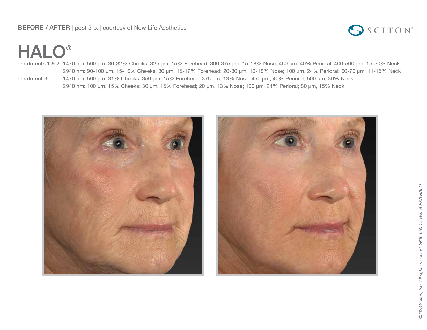 Elle Skin Beauty_& Co_halo_Before After-aa- In Florence, KY