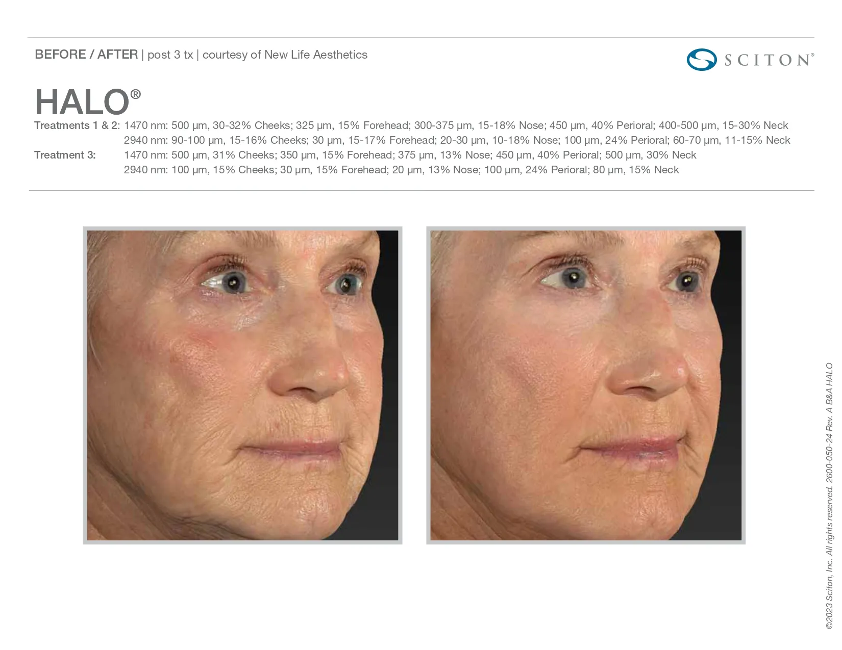 Halo for facial lines | before and after photo | Elle Skin & Beauty Co. | Florence, KY