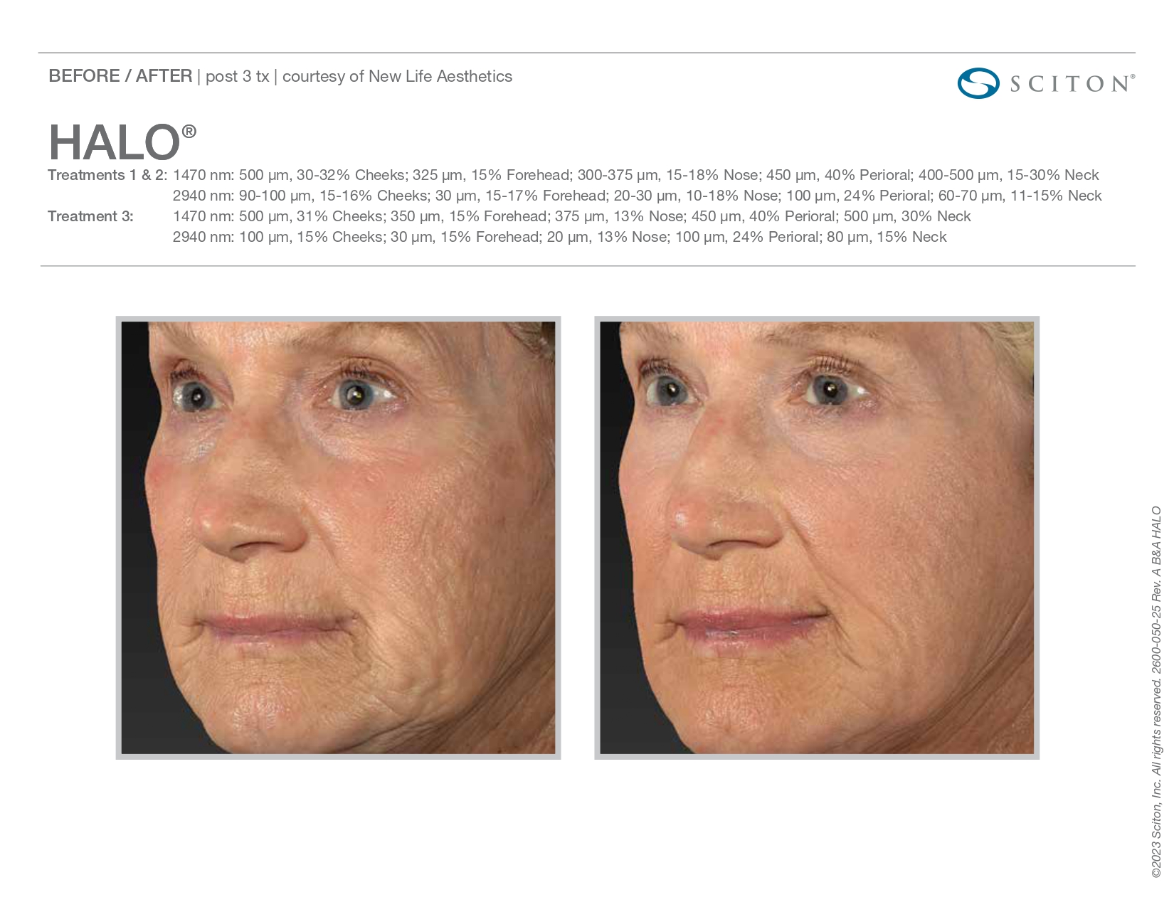 Elle Skin Beauty_& Co_halo_Before After-ab- In Florence, KY
