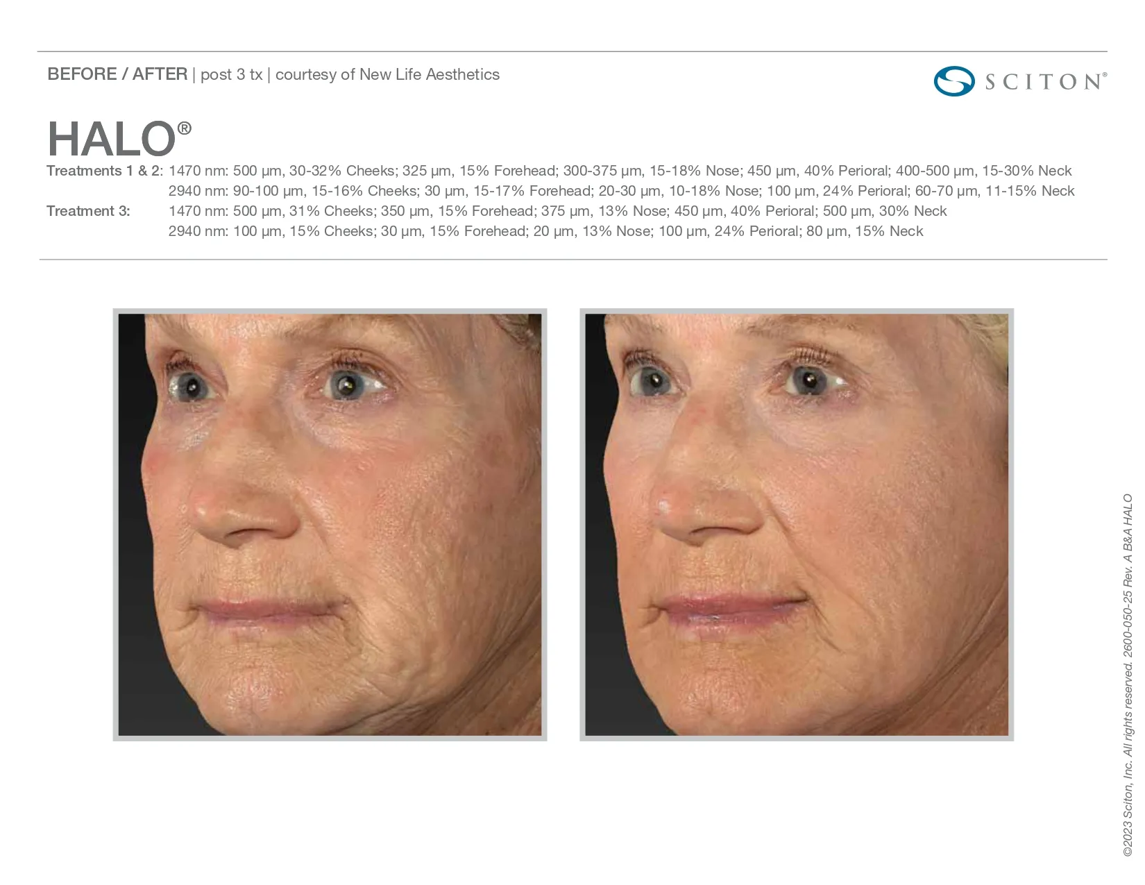 Halo for facial wrinkles | before and after photo | Elle Skin & Beauty Co. | Florence, KY