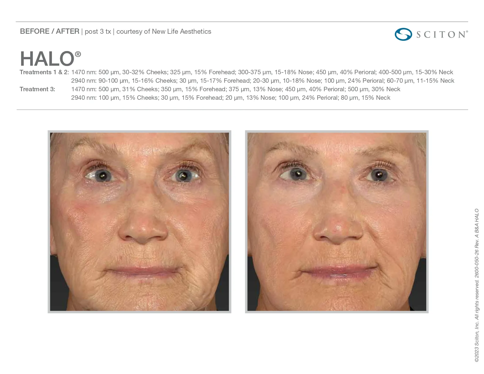 Halo for face and neck wrinkles | before and after photo | Elle Skin & Beauty Co. | Florence, KY