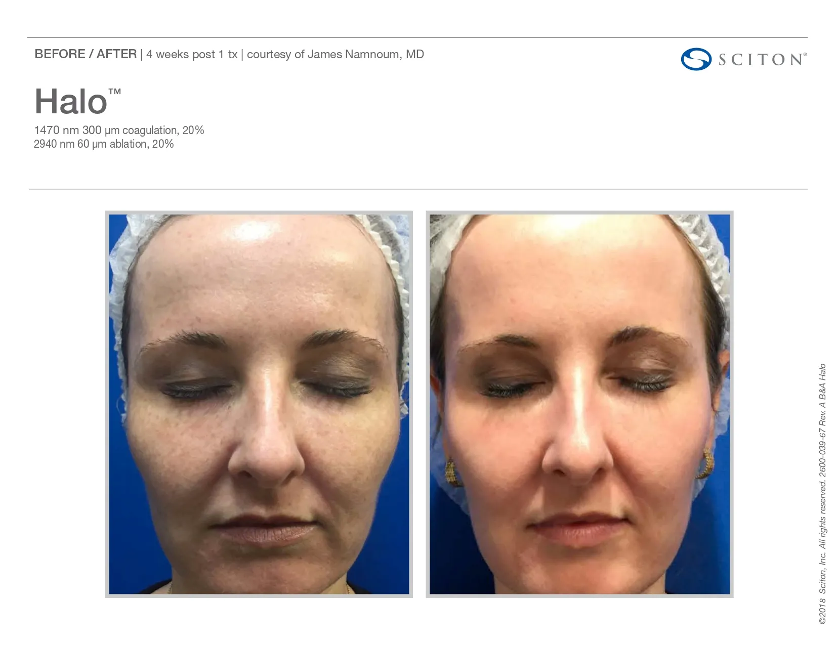 Sciton halo Treatment | before and after photo | Elle Skin & Beauty Co. | Florence, KY