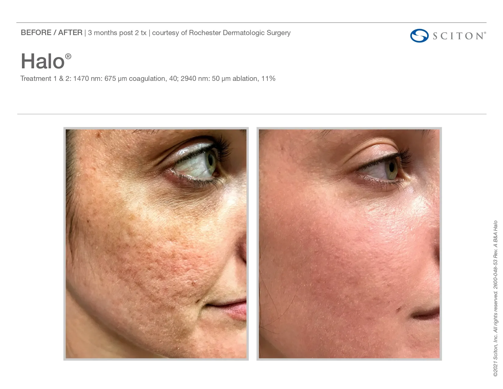 Halo Treatment for wrinkle scars on face | before and after photo | Elle Skin & Beauty Co. | Florence, KY