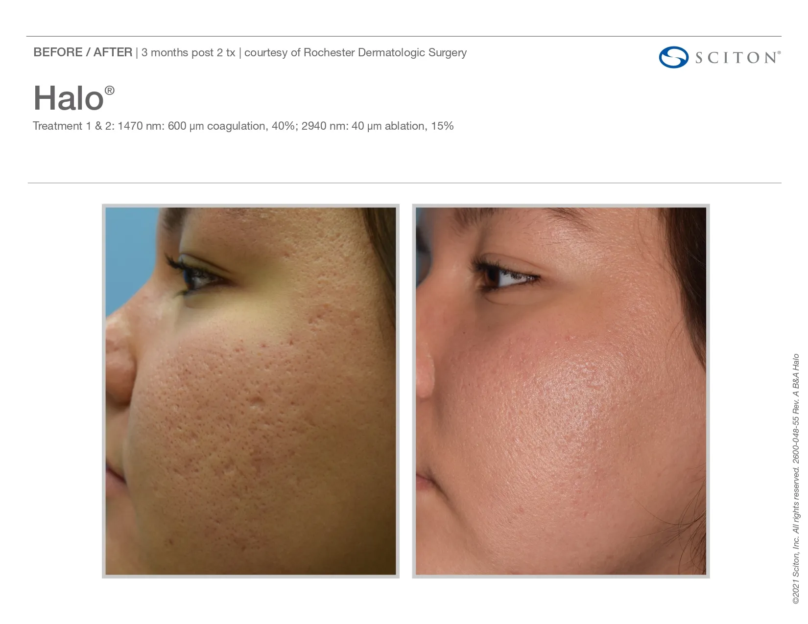 Halo for acne scars | before and after photo | Elle Skin & Beauty Co. | Florence, KY