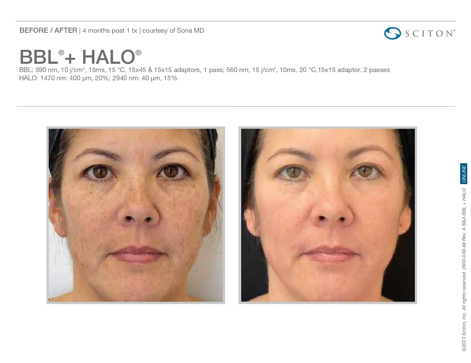 BBL + Halo for sun damage treatment | before and after photo | Elle Skin & Beauty Co. | Florence, KY