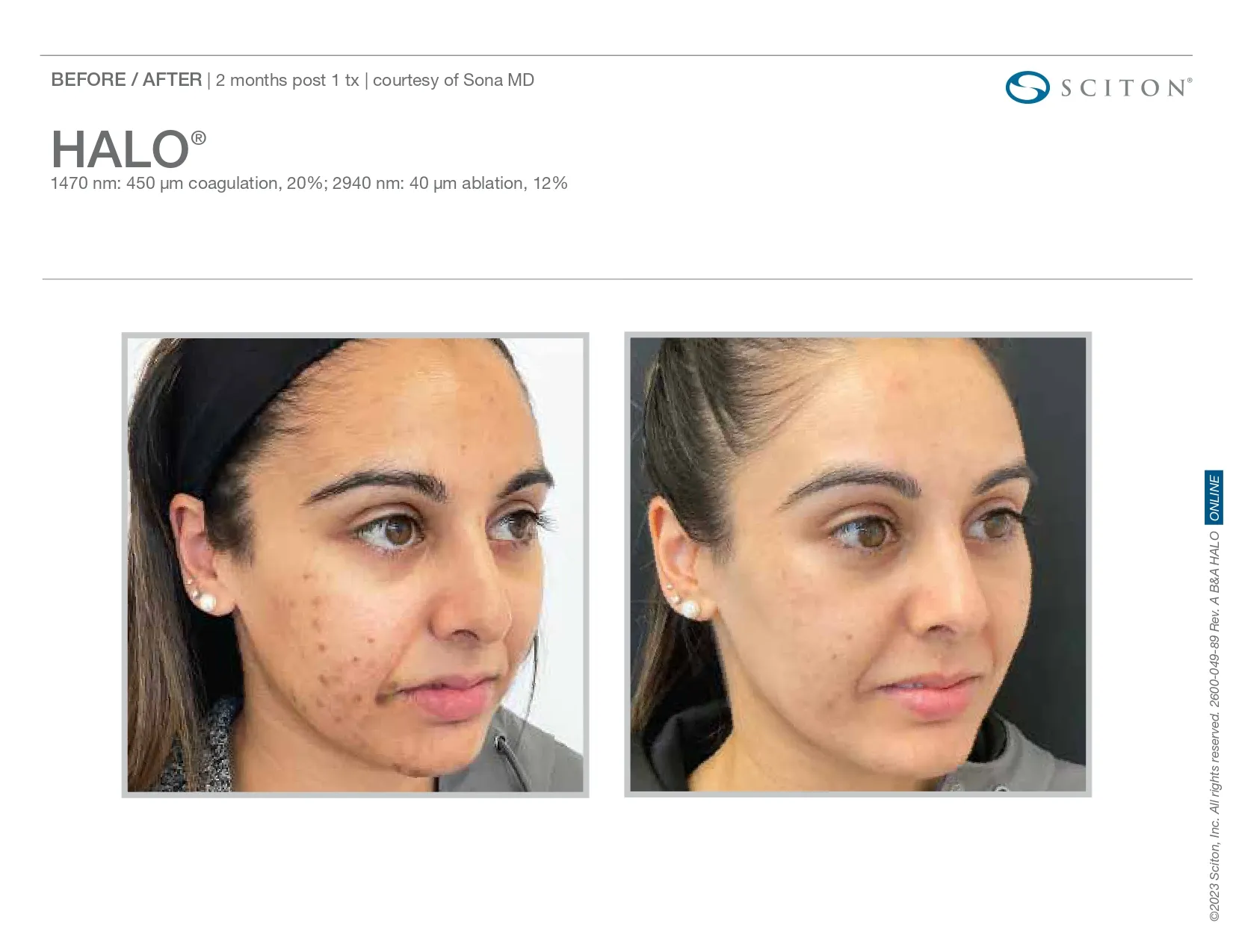 Halo for acne treatment | before and after photo | Elle Skin & Beauty Co. | Florence, KY