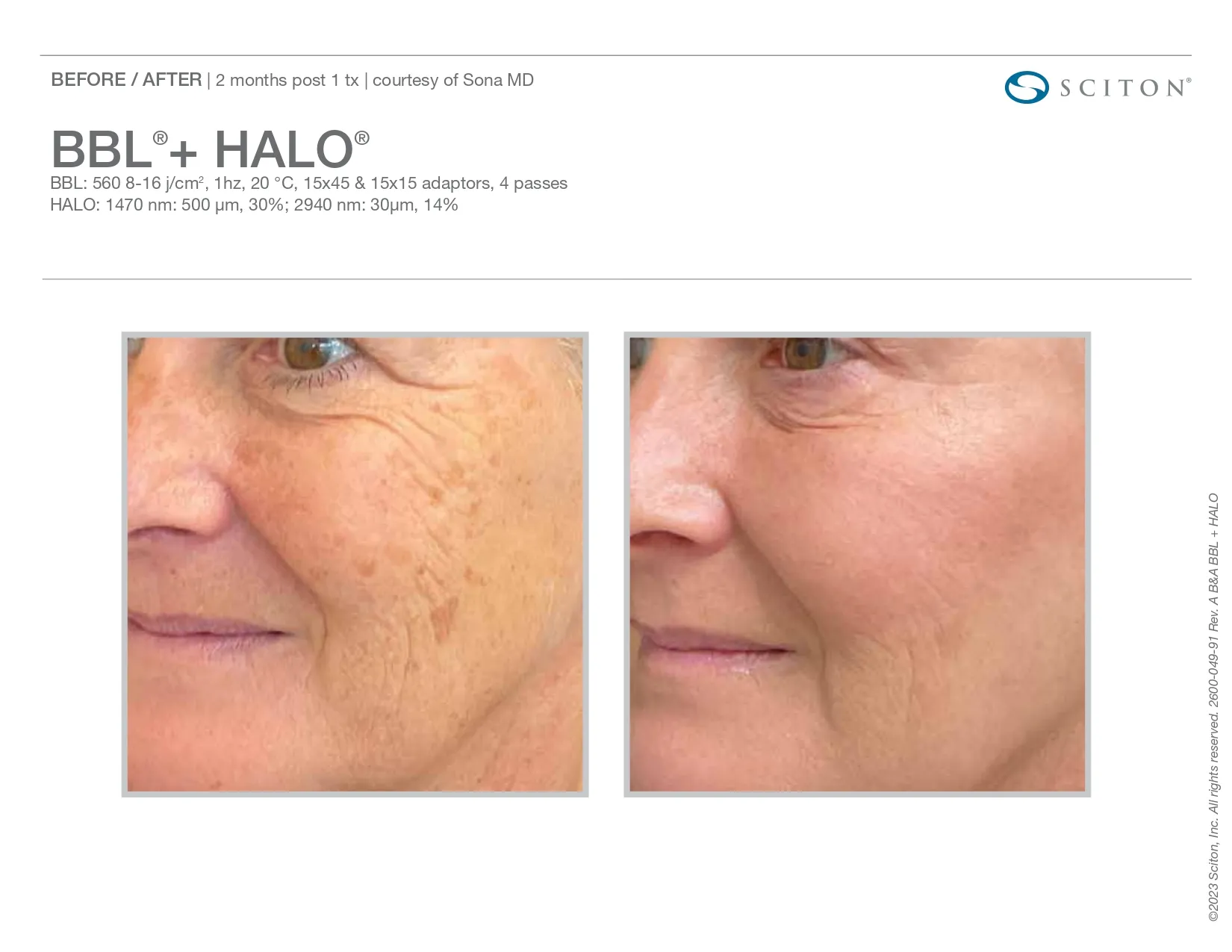 BBL + halo for skin blemishes | before and after photo | Elle Skin & Beauty Co. | Florence, KY