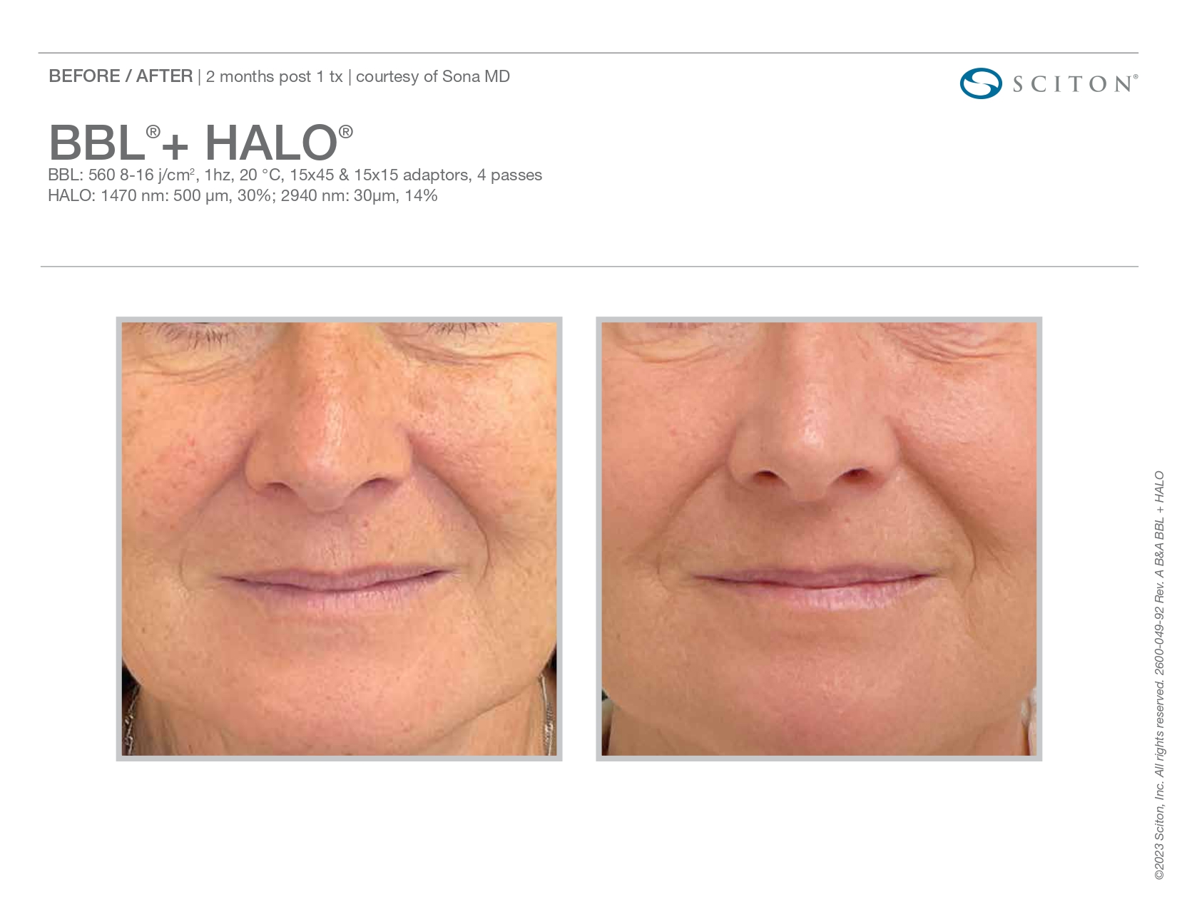 Elle Skin Beauty_& Co_halo_Before After-q- In Florence, KY
