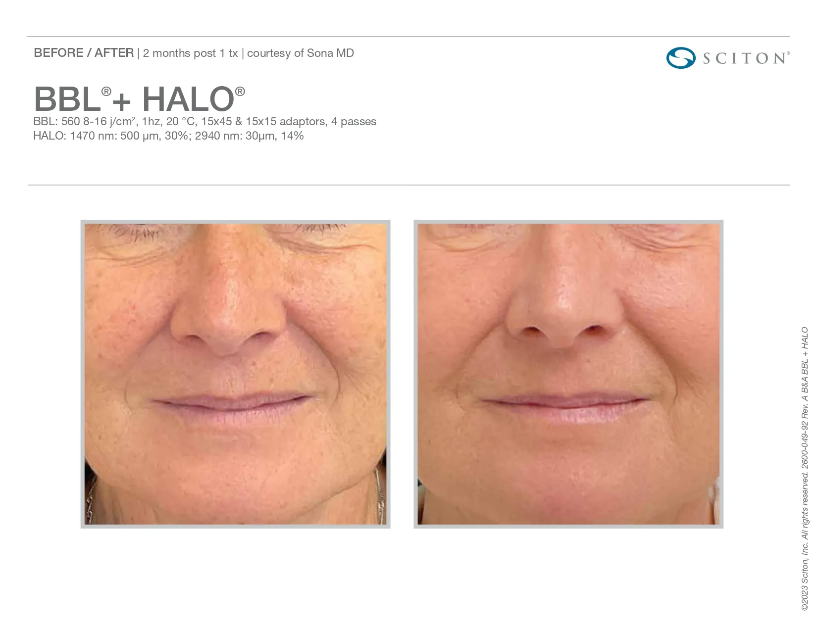 BBL + Halo for sun spots reduction | before and after photo | Elle Skin & Beauty Co. | Florence, KY