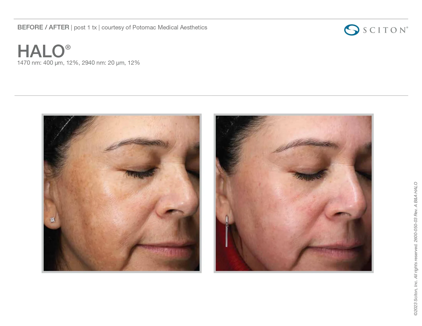 Halo for hyperpigmentation skin | before and after photo | Elle Skin & Beauty Co. | Florence, KY