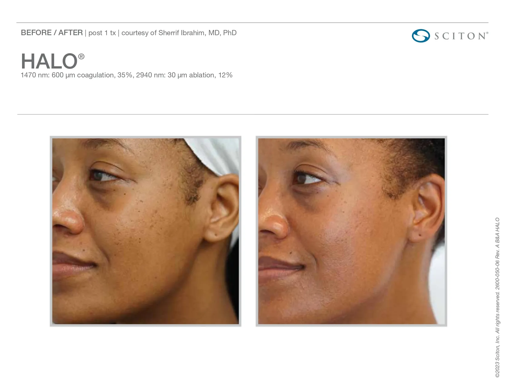 Halo Treatment for skin issues | before and after photo | Elle Skin & Beauty Co. | Florence, KY