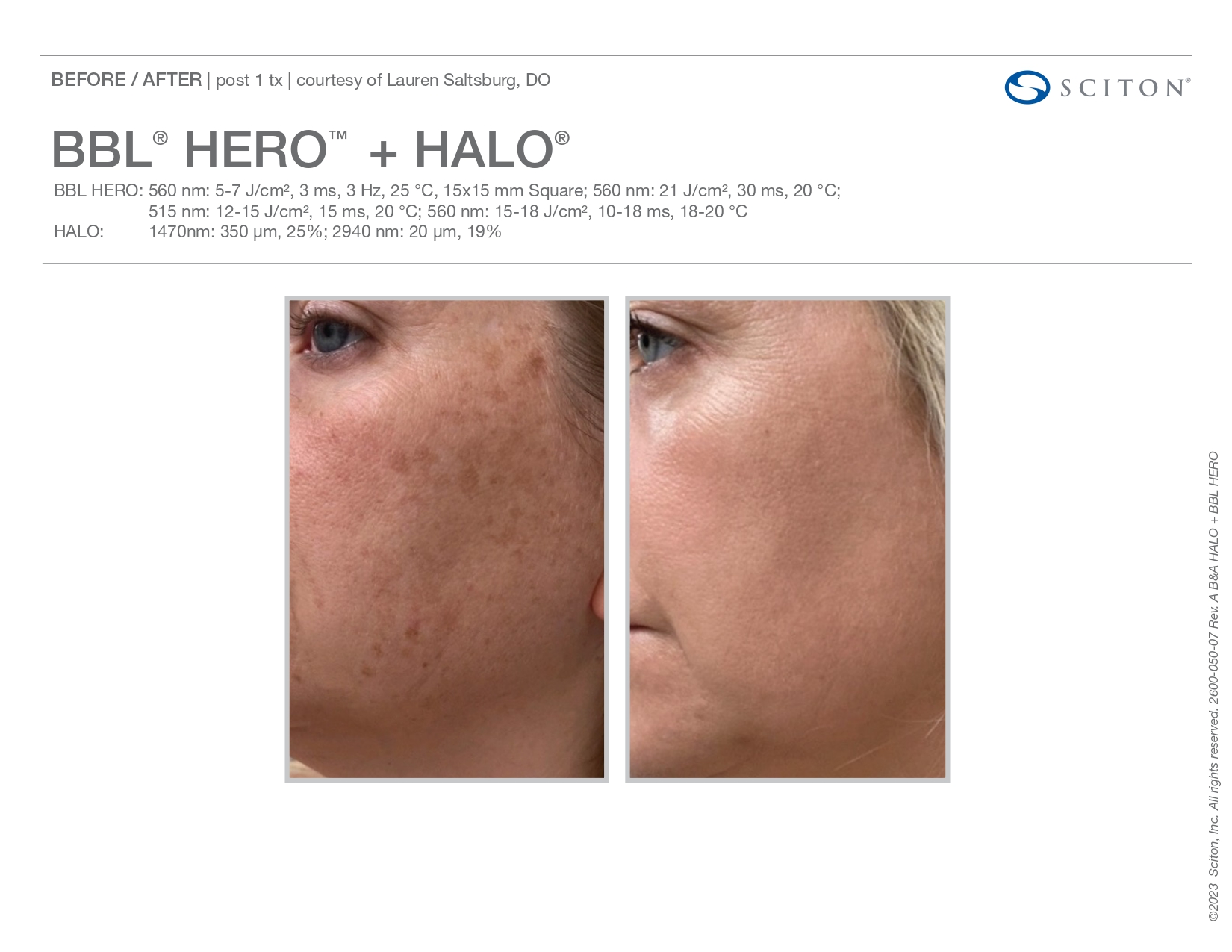 Elle Skin Beauty_& Co_halo_Before After-t- In Florence, KY