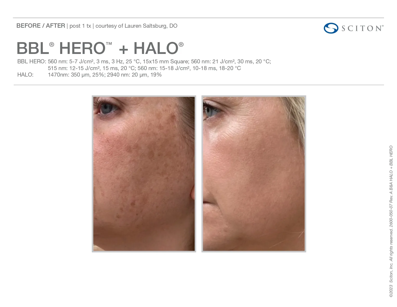 BBL Hero + Halo | before and after photo | Elle Skin & Beauty Co. | Florence, KY