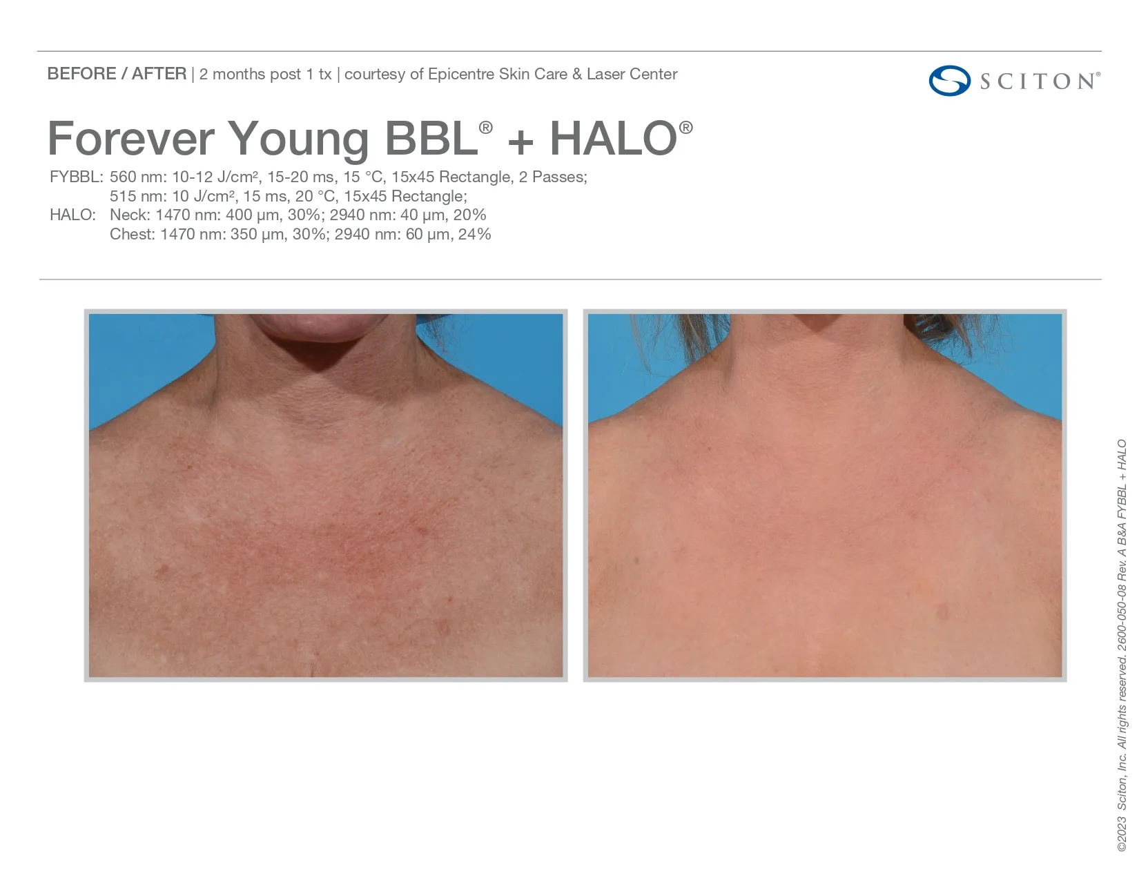 Forever Young BBL + Halo | before and after photo | Elle Skin & Beauty Co. | Florence, KY