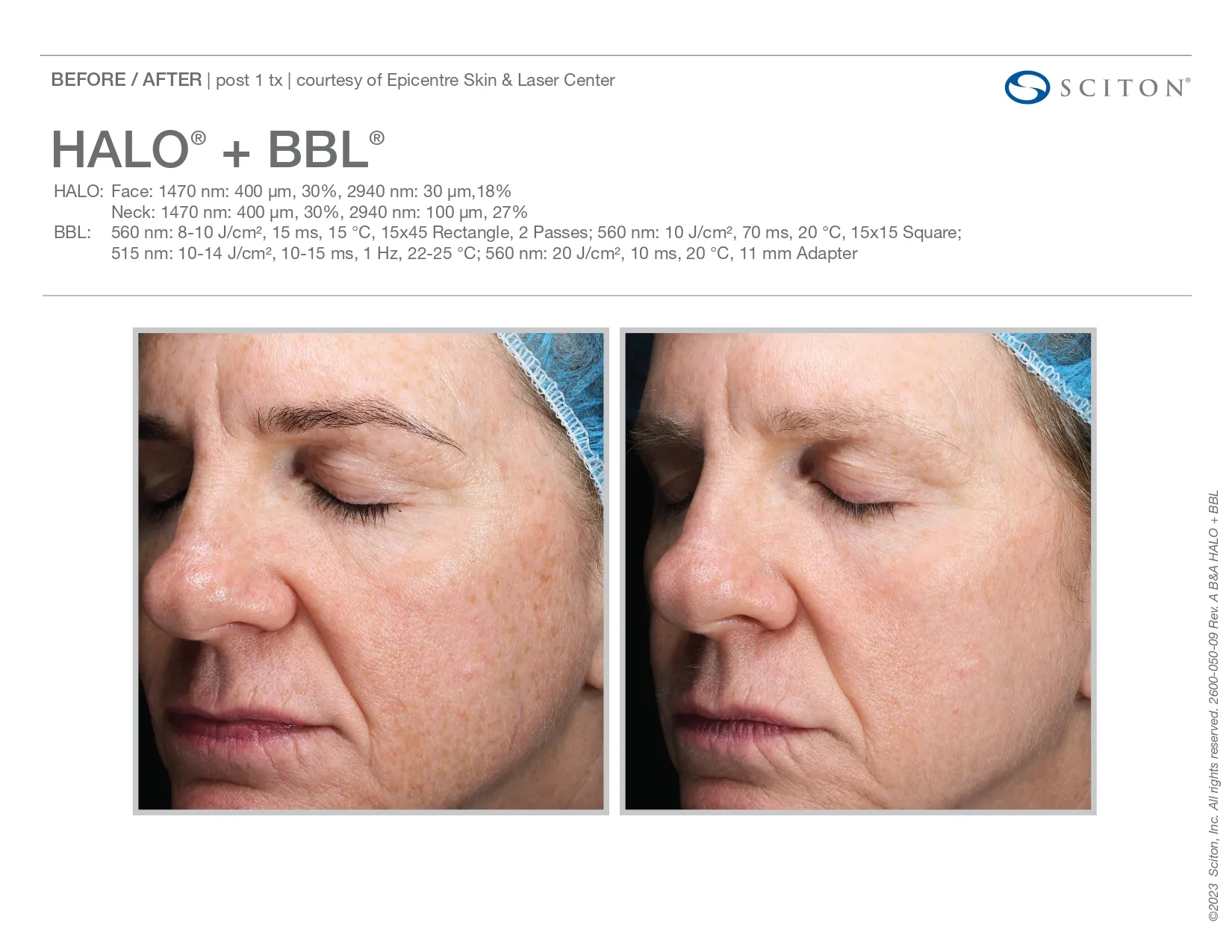 Halo + BBL Treatment | before and after photo | Elle Skin & Beauty Co. | Florence, KY