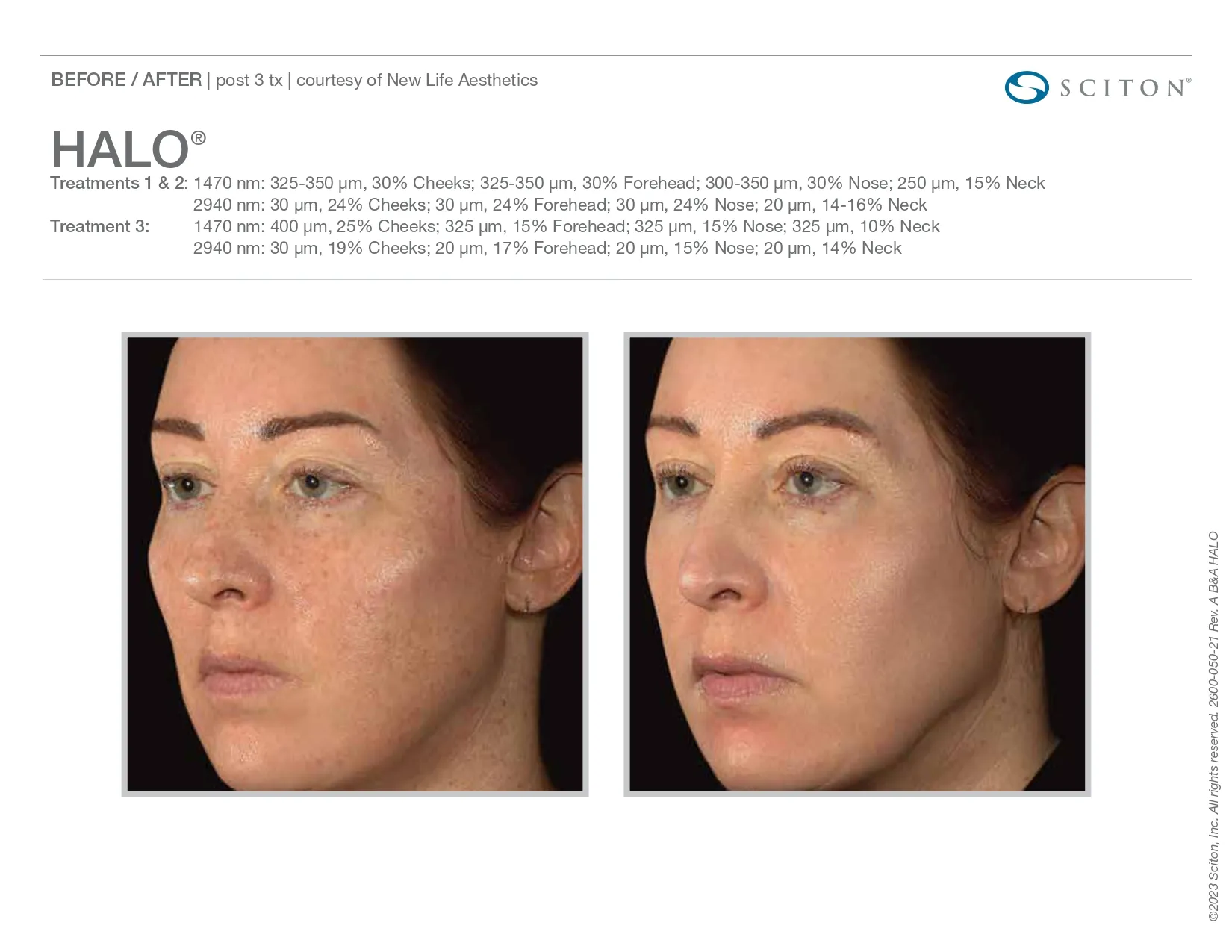 Halo for sun spots treatment before and after photo | Elle Skin & Beauty Co. | Florence, KY