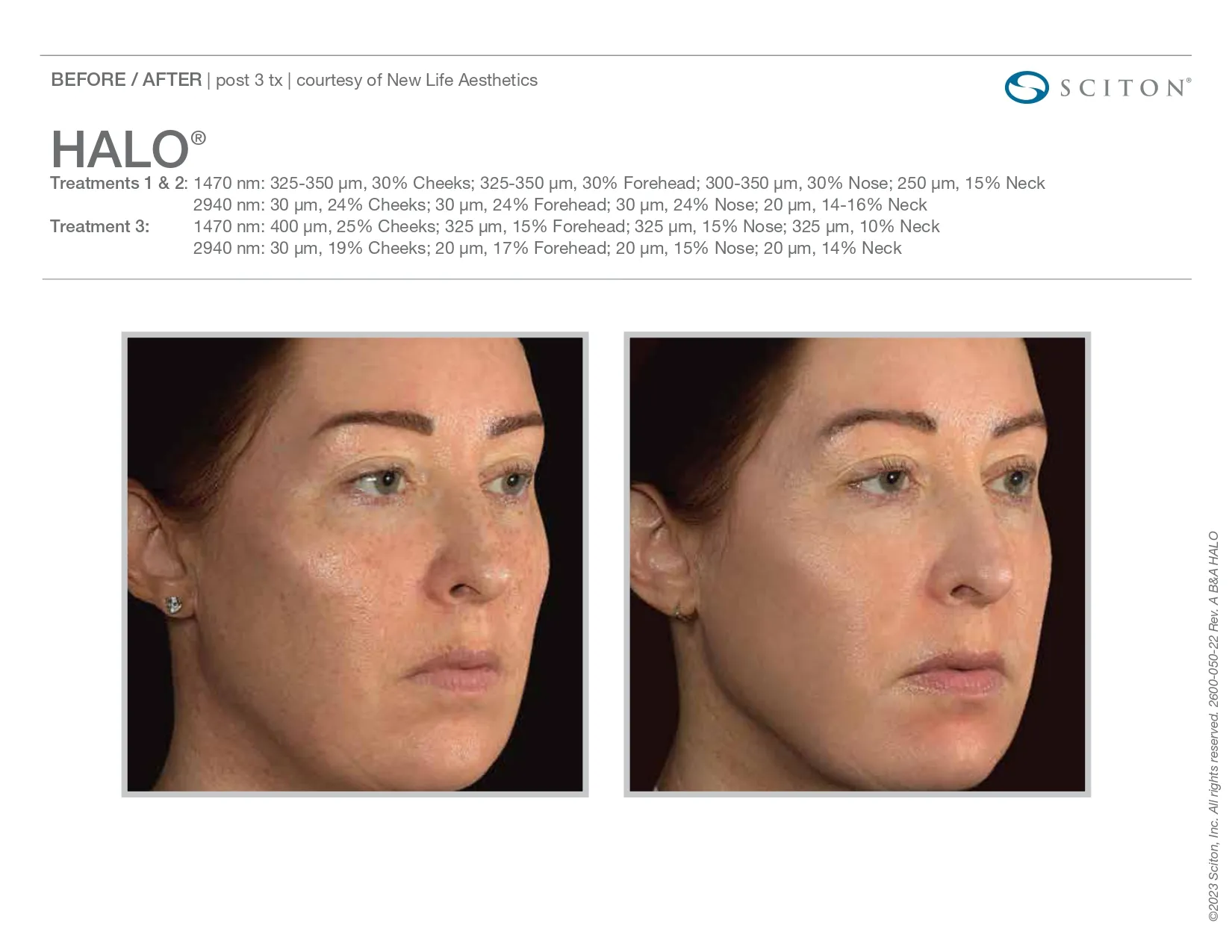 Halo for skin issues | before and after photo | Elle Skin & Beauty Co. | Florence, KY