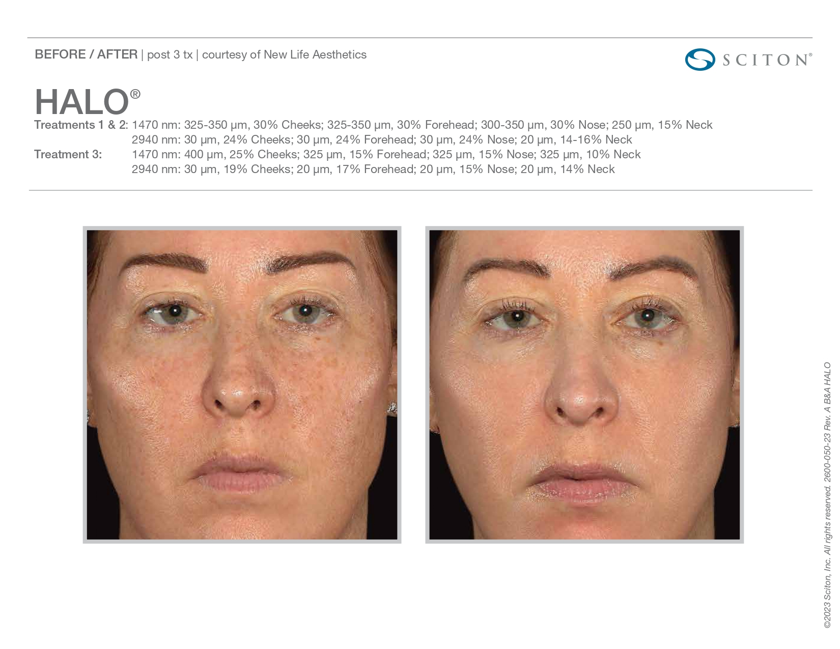 Elle Skin Beauty_& Co_halo_Before After-z- In Florence, KY