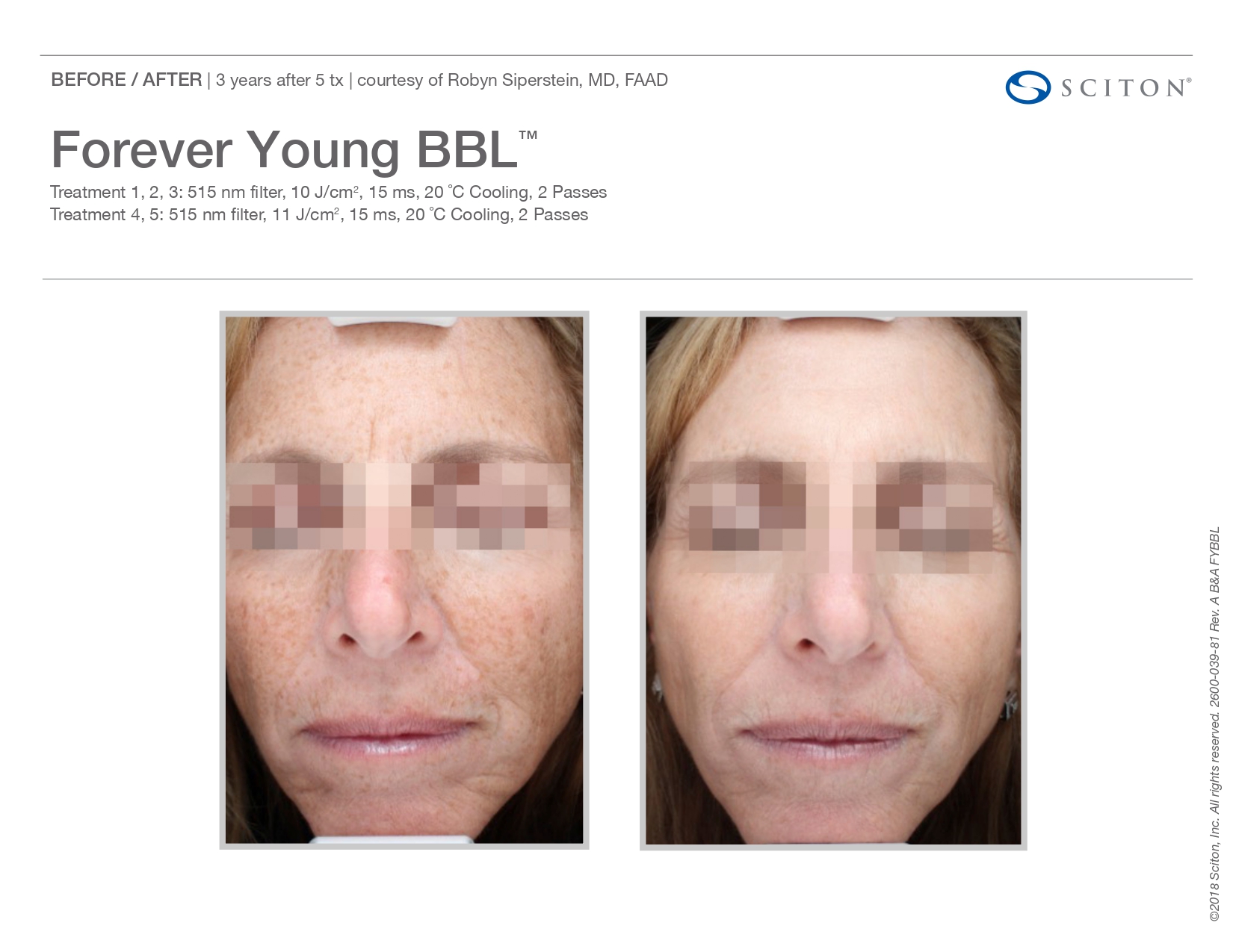 Elle Skin Beauty_& Co_FYBBL_Before After-L- In Florence, KY