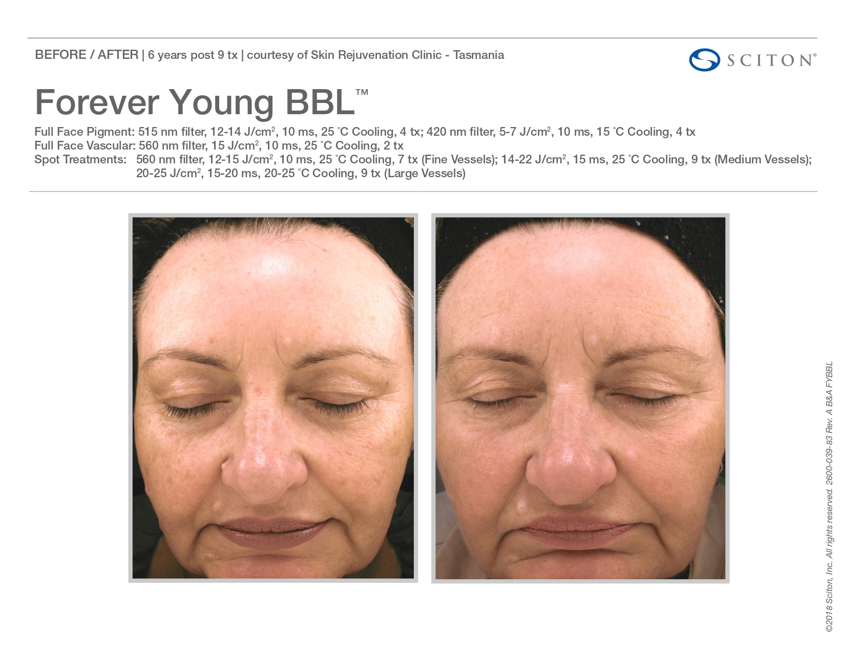Elle Skin Beauty_& Co_FYBBL_Before After-M- In Florence, KY