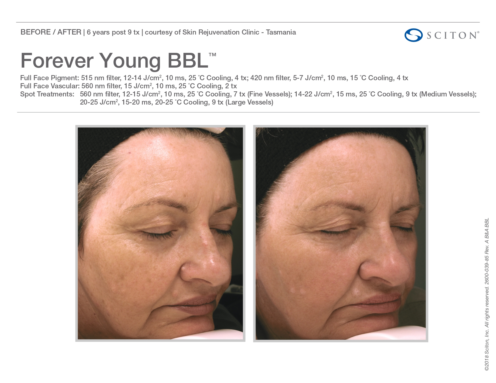 Elle Skin Beauty_& Co_FYBBL_Before After-O- In Florence, KY