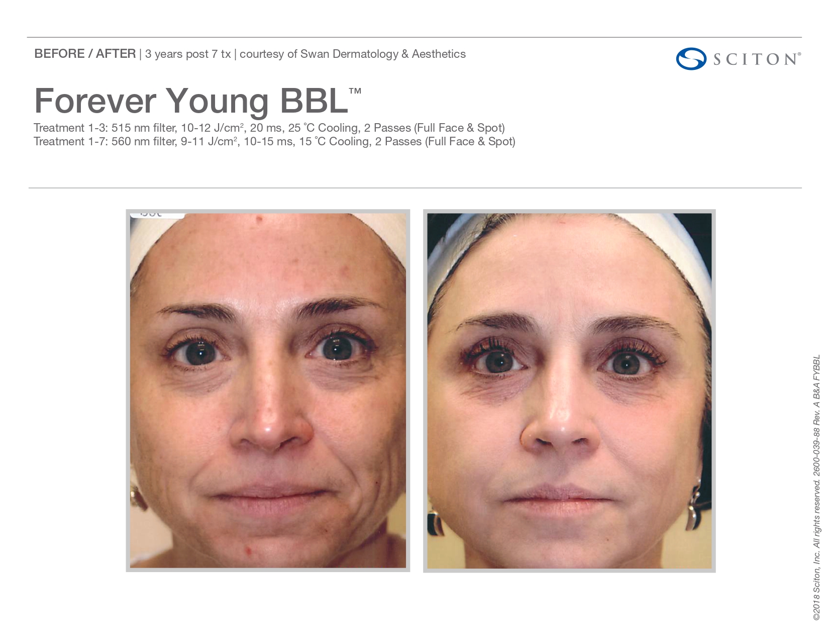 Elle Skin Beauty_& Co_FYBBL_Before After-P- In Florence, KY