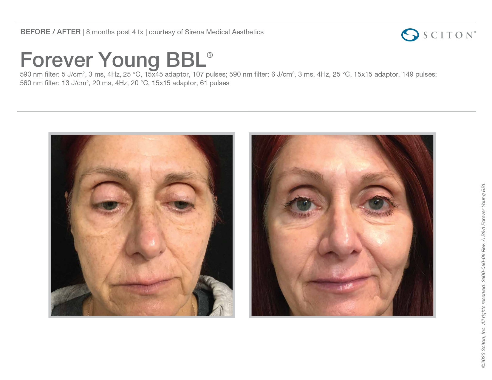 Elle Skin Beauty_& Co_FYBBL_Before After-T- In Florence, KY