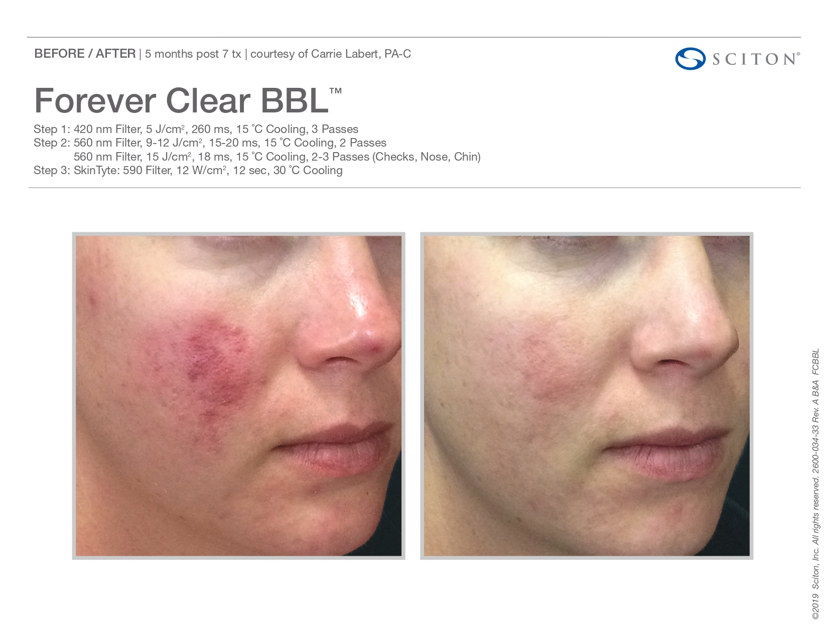 Elle Skin Beauty_& Co_clearBBL_Before After-a- In Florence, KY