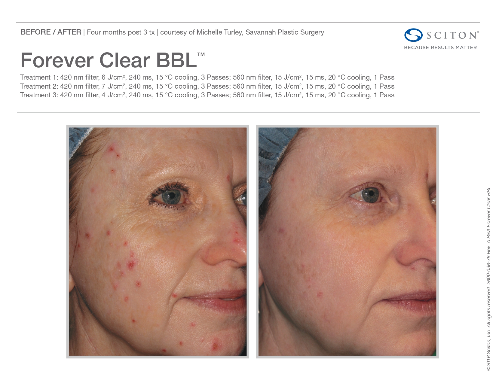 Elle Skin Beauty_& Co_clearBBL_Before After-b- In Florence, KY