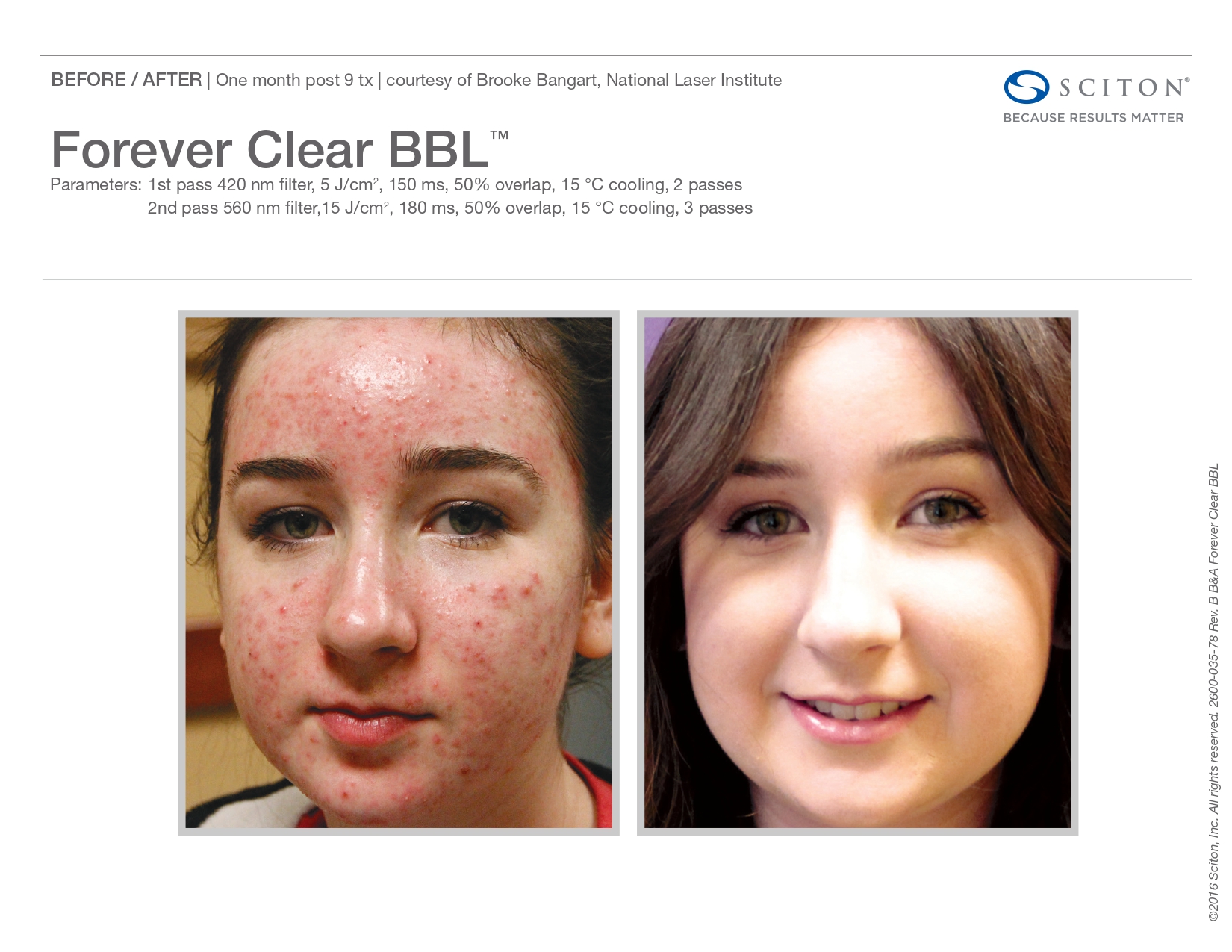 Elle Skin Beauty_& Co_clearBBL_Before After-c- In Florence, KY