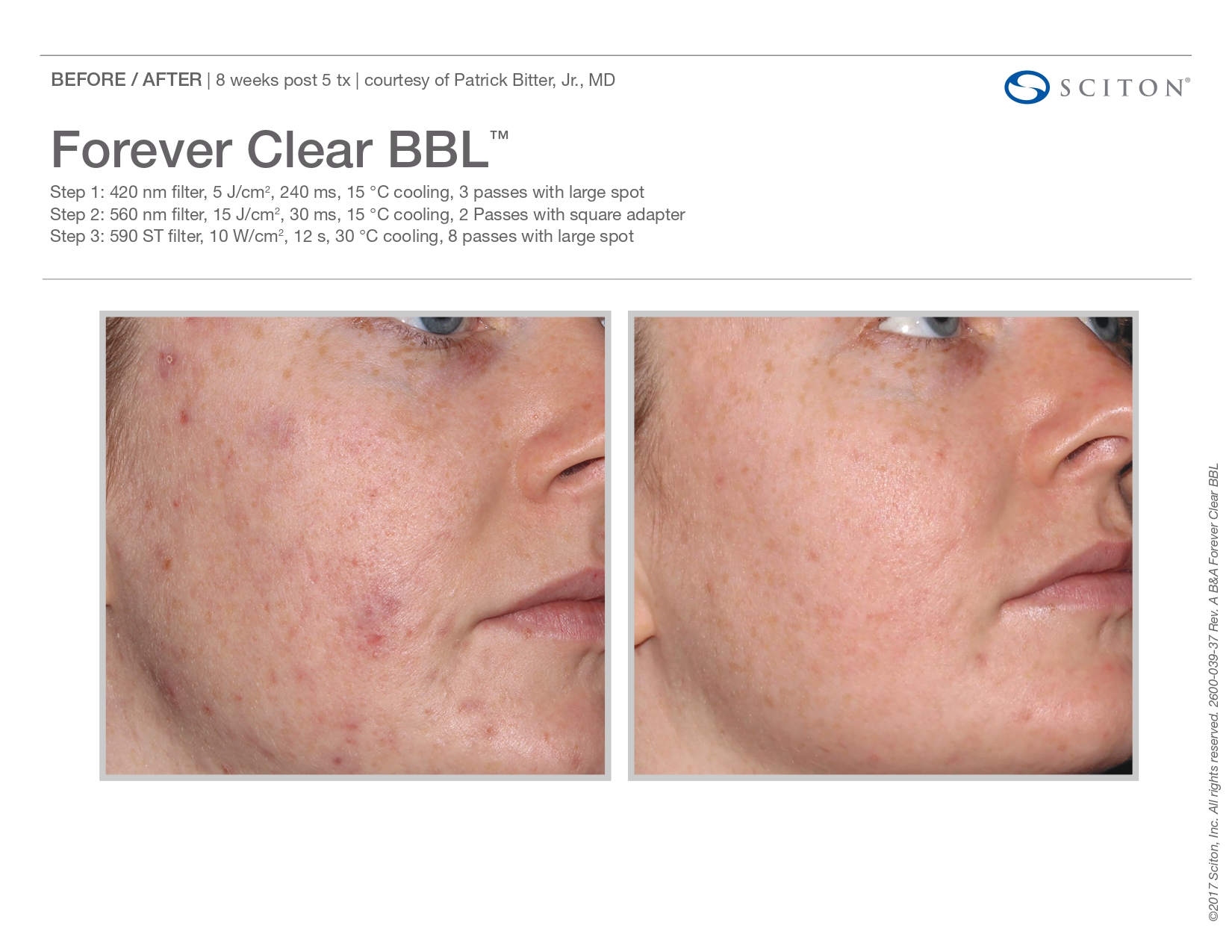 Elle Skin Beauty_& Co_clearBBL_Before After-d- In Florence, KY