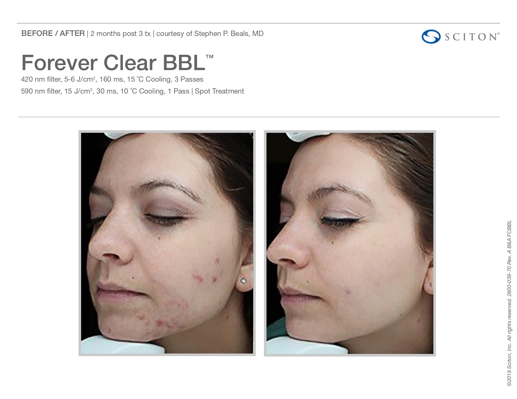 Elle Skin Beauty_& Co_clearBBL_Before After-h- In Florence, KY