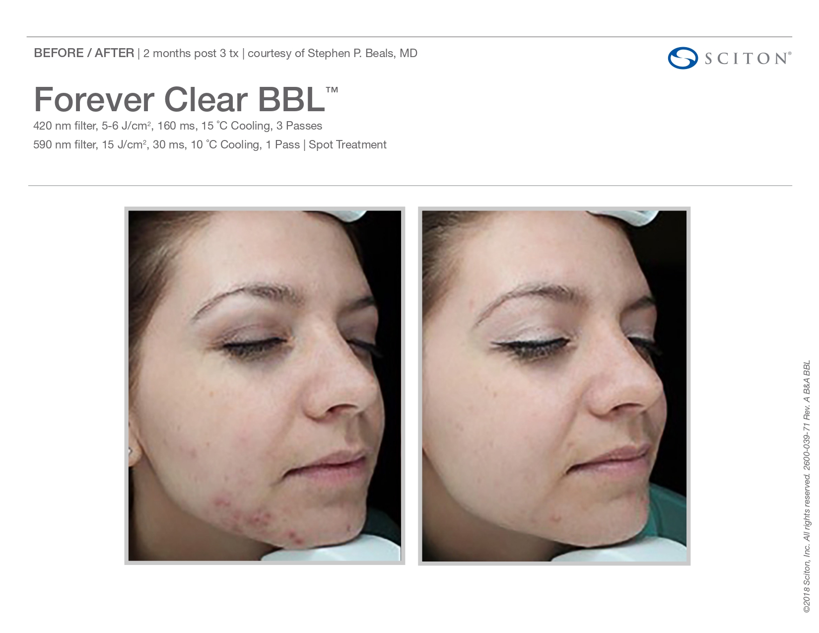 Elle Skin Beauty_& Co_clearBBL_Before After-i- In Florence, KY