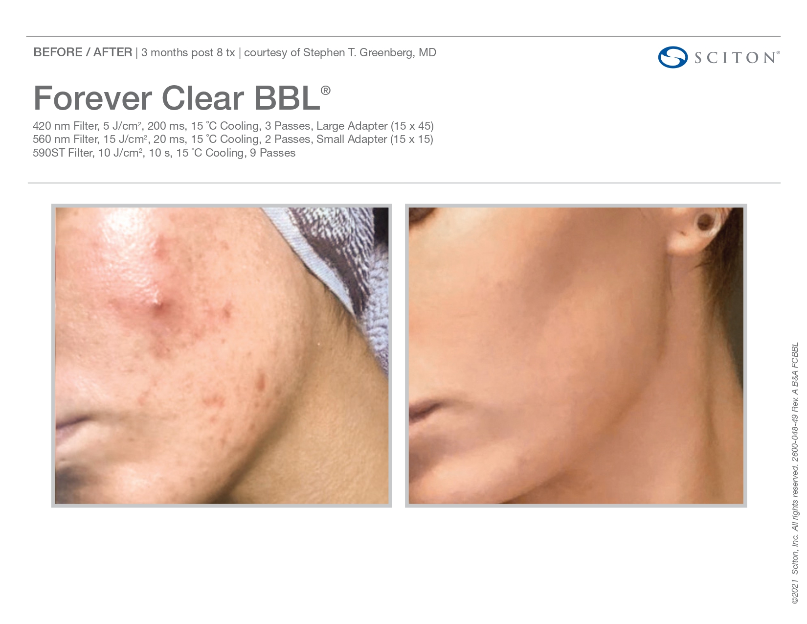 Elle Skin Beauty_& Co_clearBBL_Before After-k- In Florence, KY