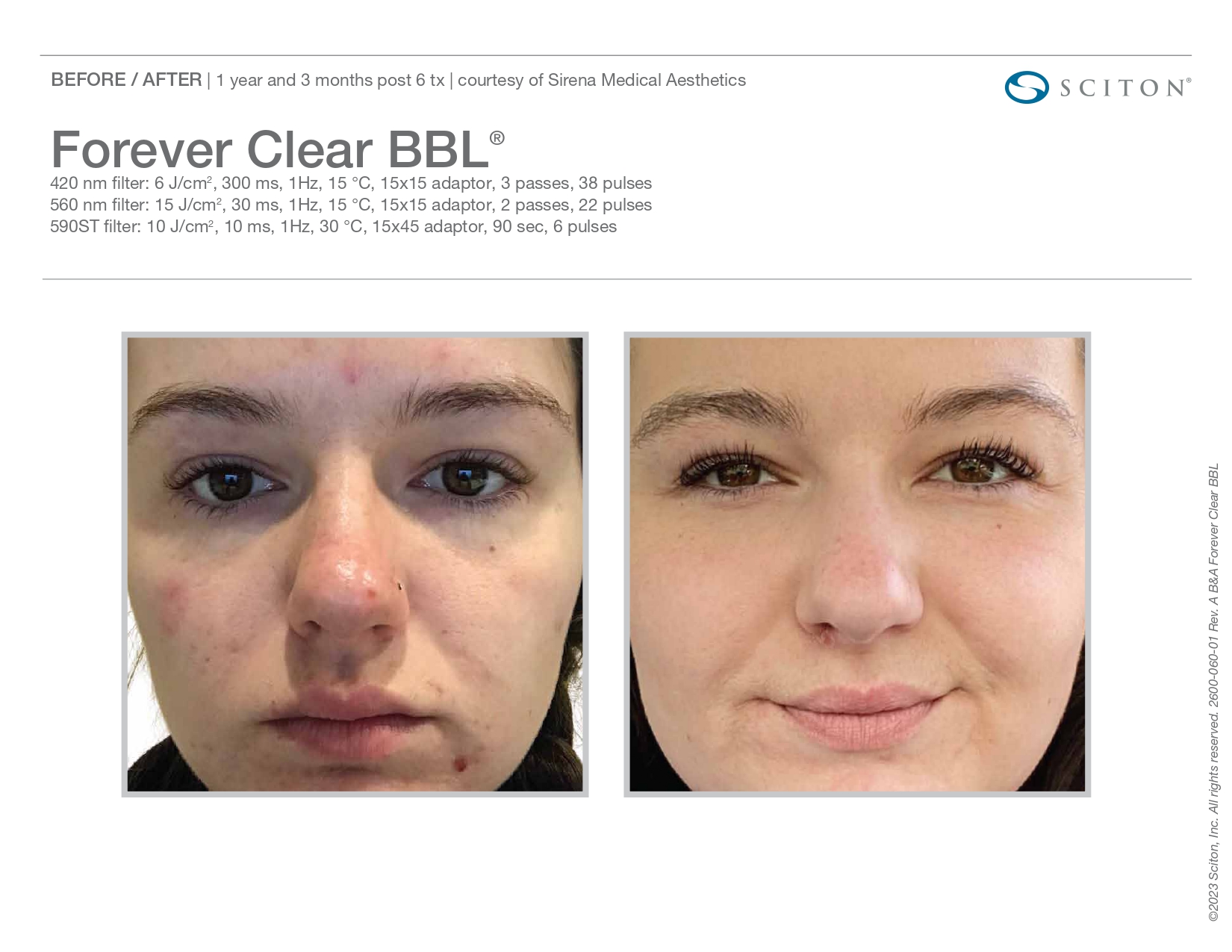 Elle Skin Beauty_& Co_clearBBL_Before After-l- In Florence, KY