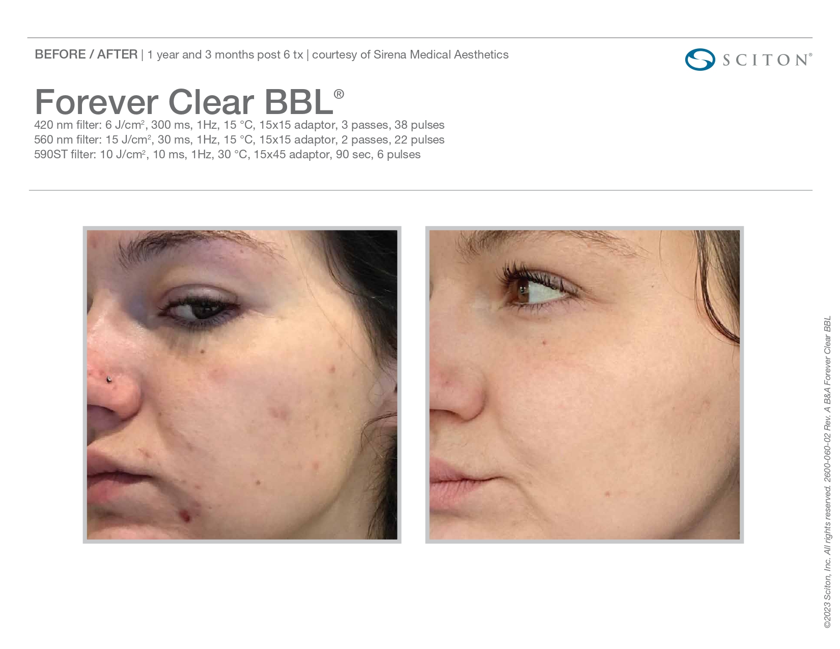 Elle Skin Beauty_& Co_clearBBL_Before After-m- In Florence, KY