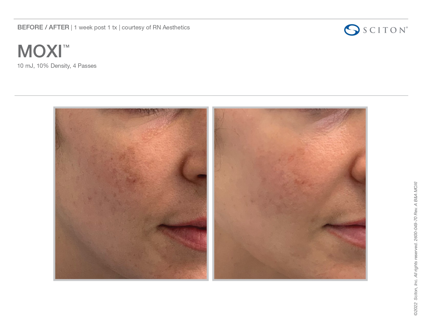 Elle Skin Beauty_& Co_moxi_Before After-c- In Florence, KY
