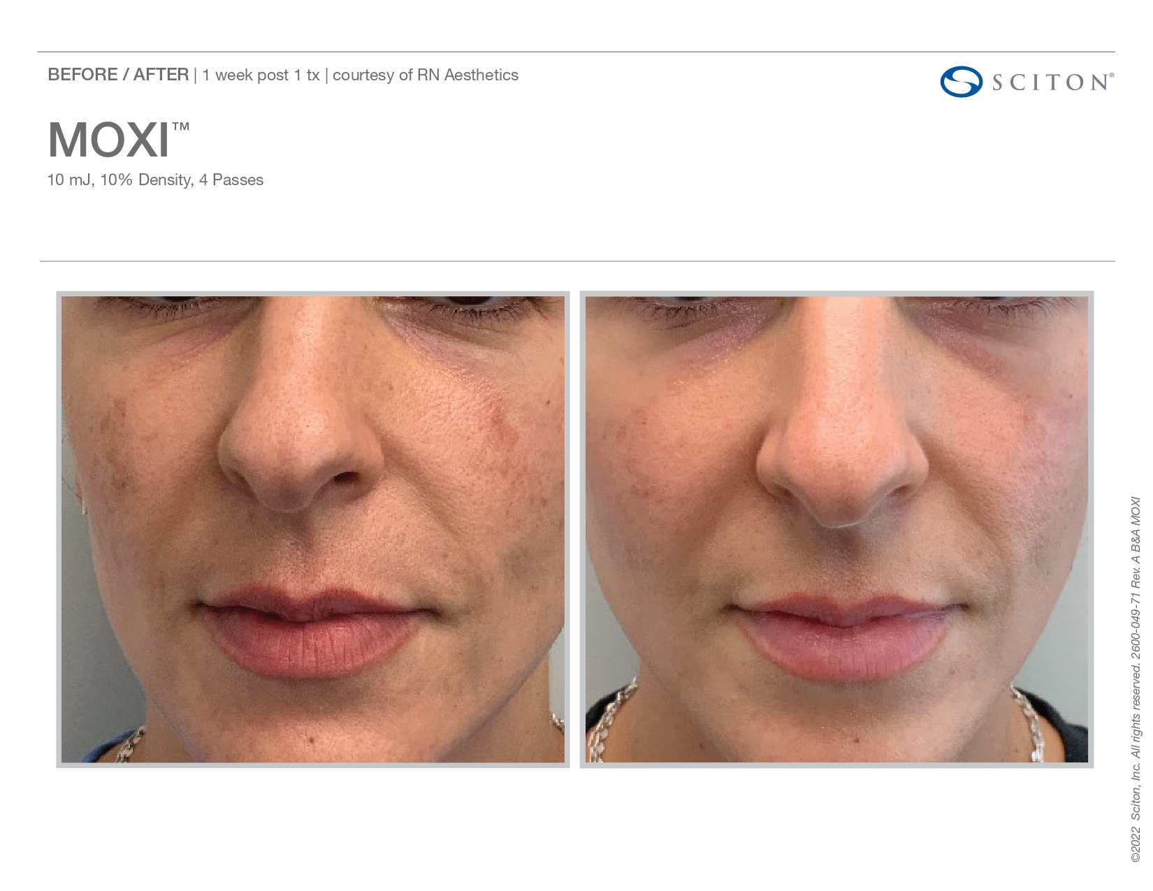 Elle Skin Beauty_& Co_moxi_Before After-d- In Florence, KY