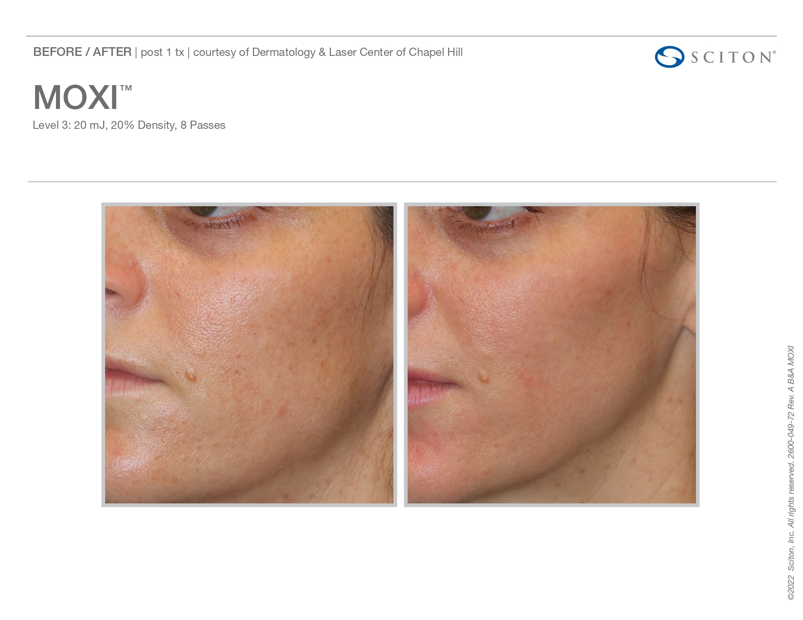 Elle Skin Beauty_& Co_moxi_Before After-e- In Florence, KY