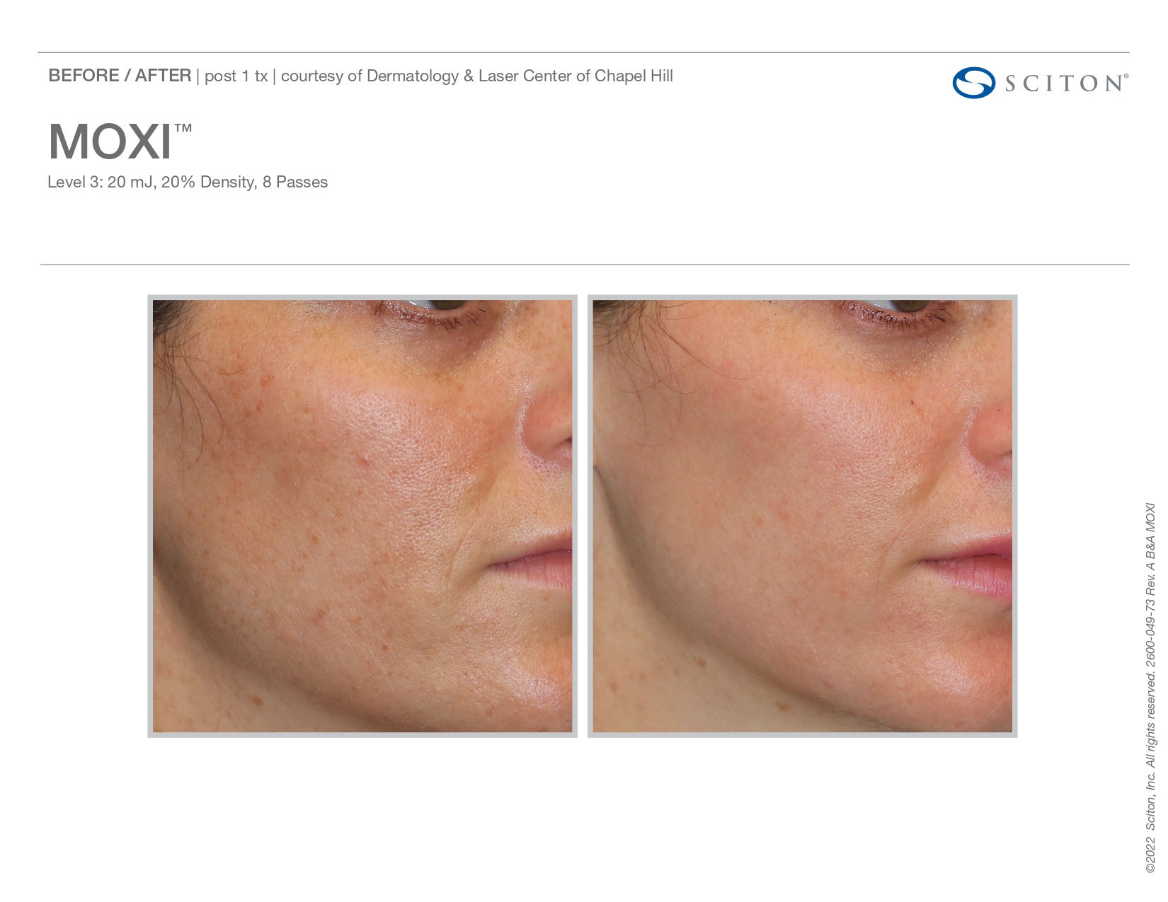 Elle Skin Beauty_& Co_moxi_Before After-f- In Florence, KY