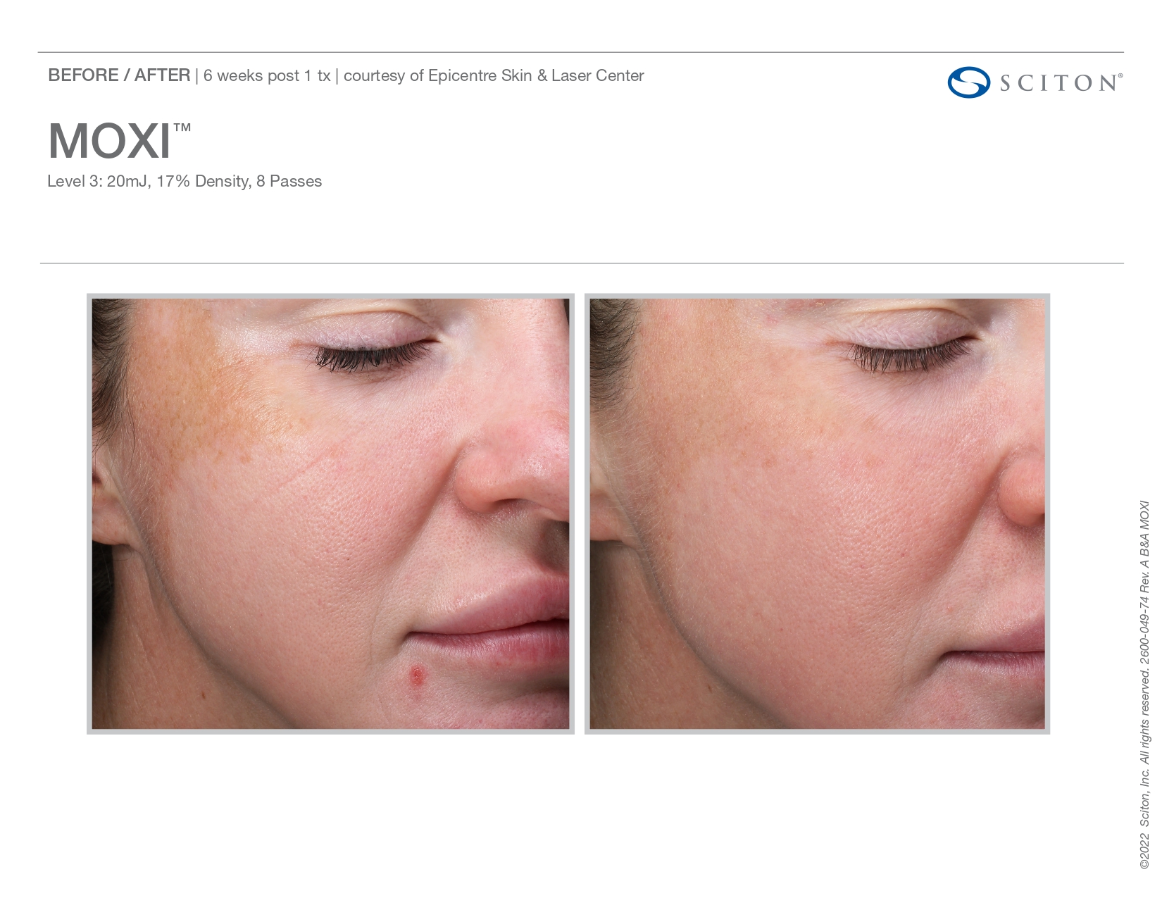 Elle Skin Beauty_& Co_moxi_Before After-g- In Florence, KY