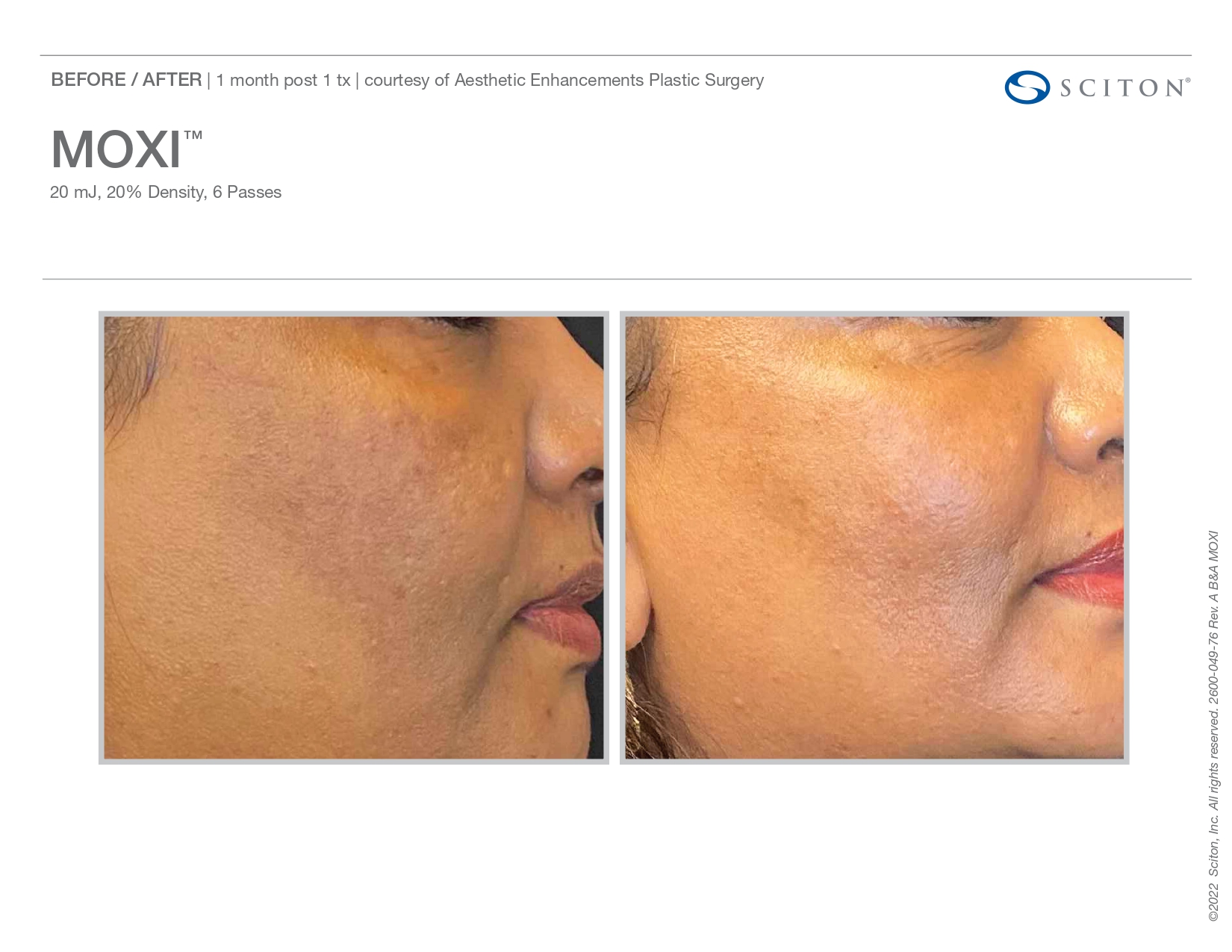 Elle Skin Beauty_& Co_moxi_Before After-i- In Florence, KY
