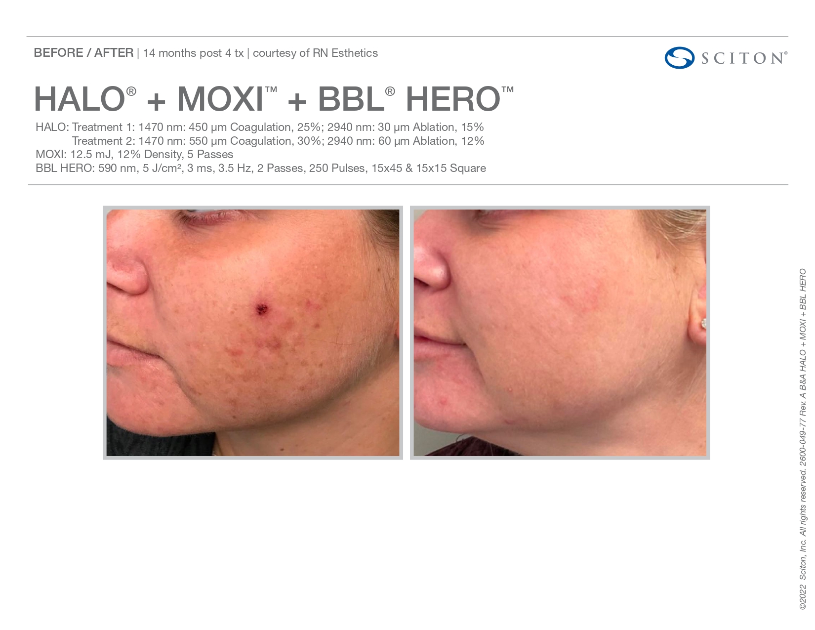 Elle Skin Beauty_& Co_moxi_Before After-j- In Florence, KY