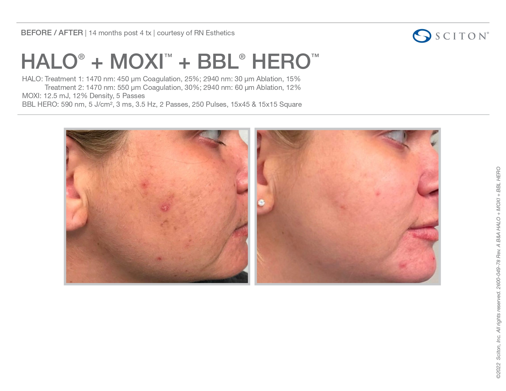Elle Skin Beauty_& Co_moxi_Before After-k- In Florence, KY