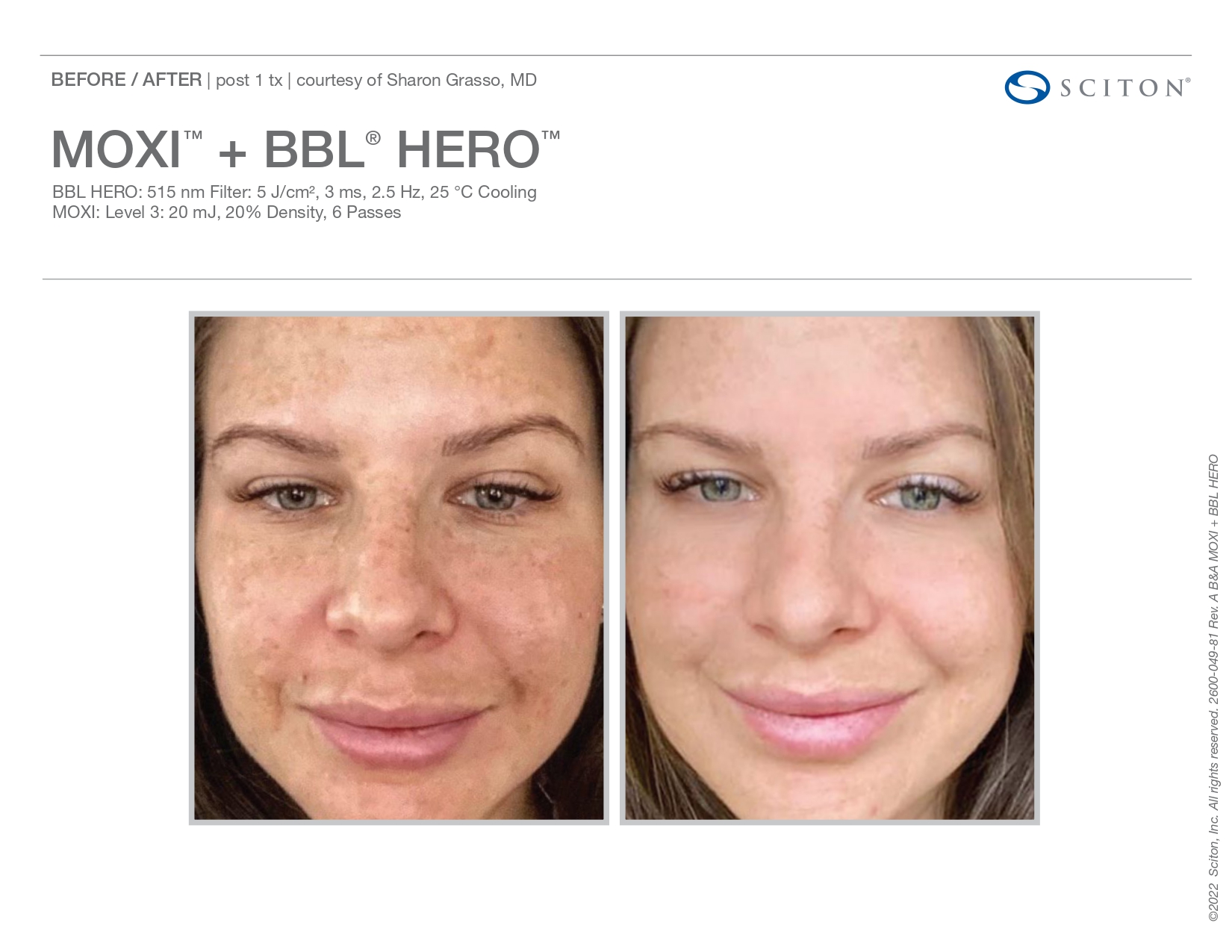 Elle Skin Beauty_& Co_moxi_Before After-n- In Florence, KY