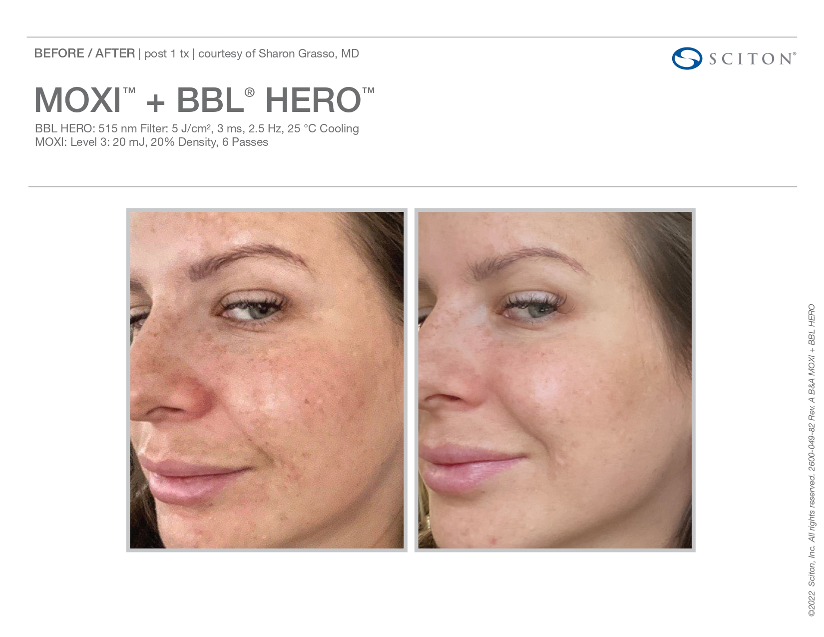 Elle Skin Beauty_& Co_moxi_Before After-o- In Florence, KY