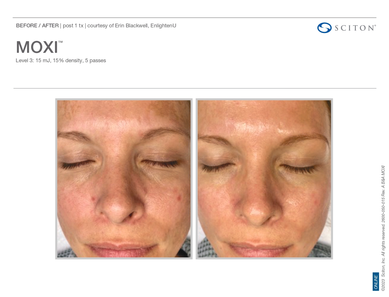 Elle Skin Beauty_& Co_moxi_Before After-r- In Florence, KY