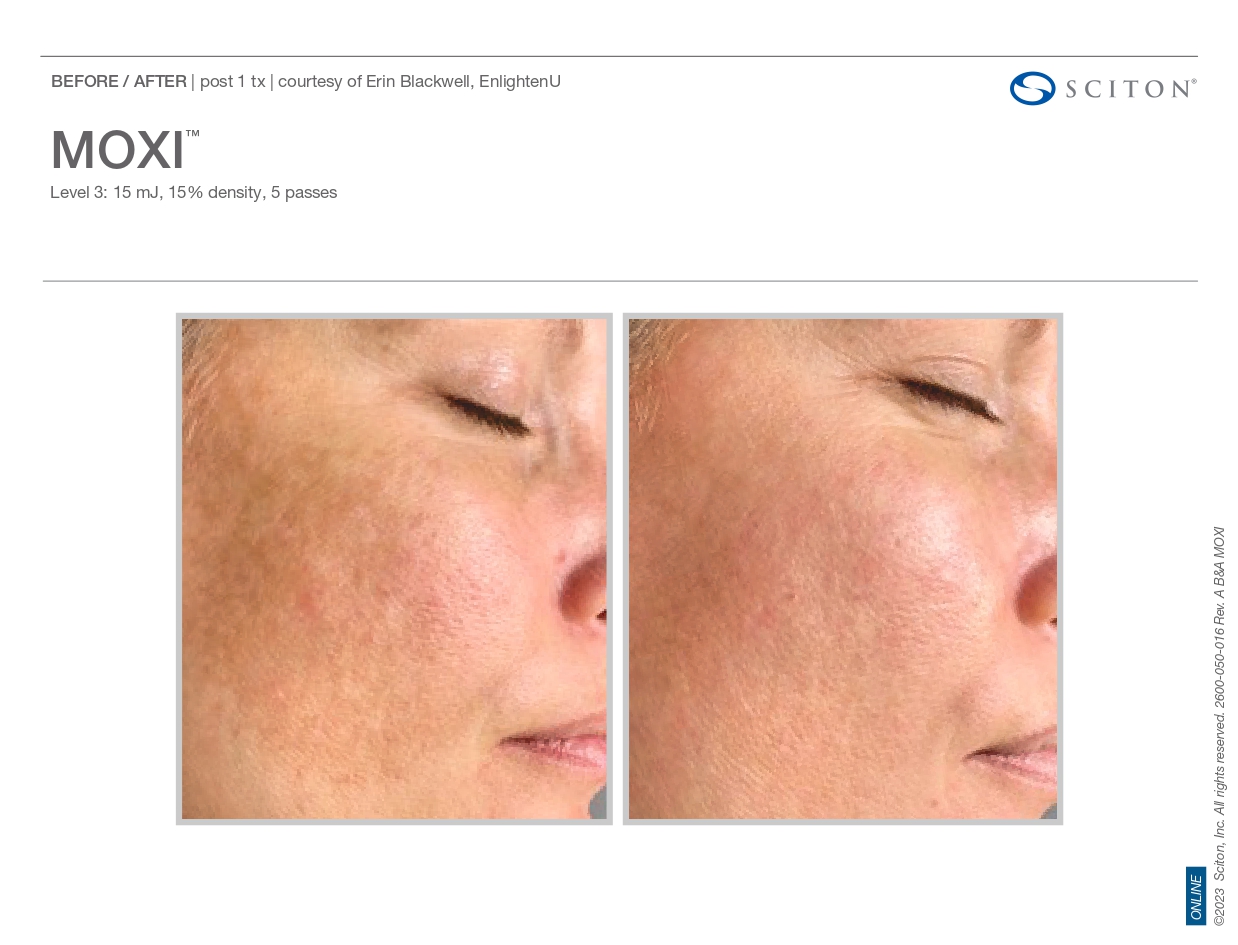 Elle Skin Beauty_& Co_moxi_Before After-s- In Florence, KY