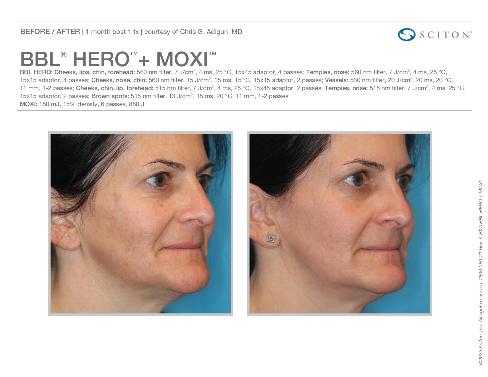 Elle Skin Beauty_& Co_moxi_Before After-u- In Florence, KY